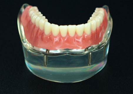 Snap-In Dentures